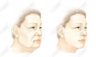做了筋膜提升多久脸型可以出来 全脸筋膜提升多少钱